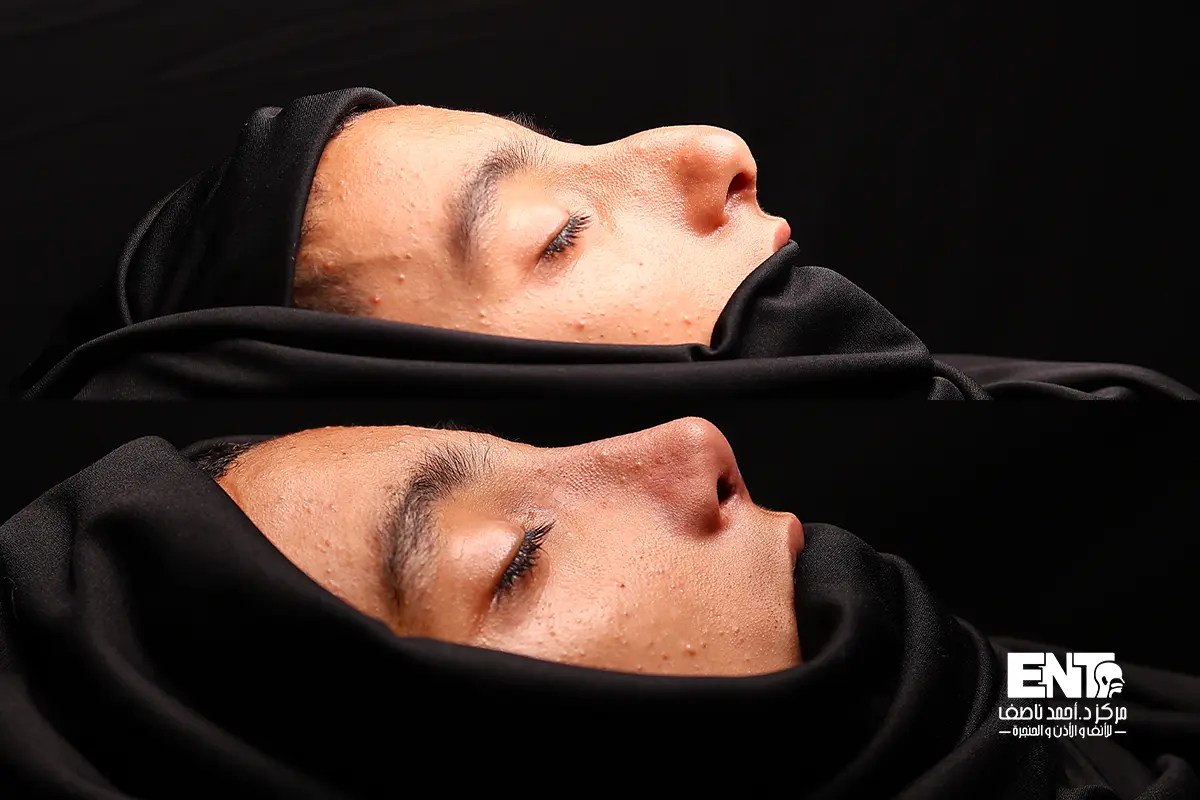 دكتور تجميل انف وظيفي في المنصورة