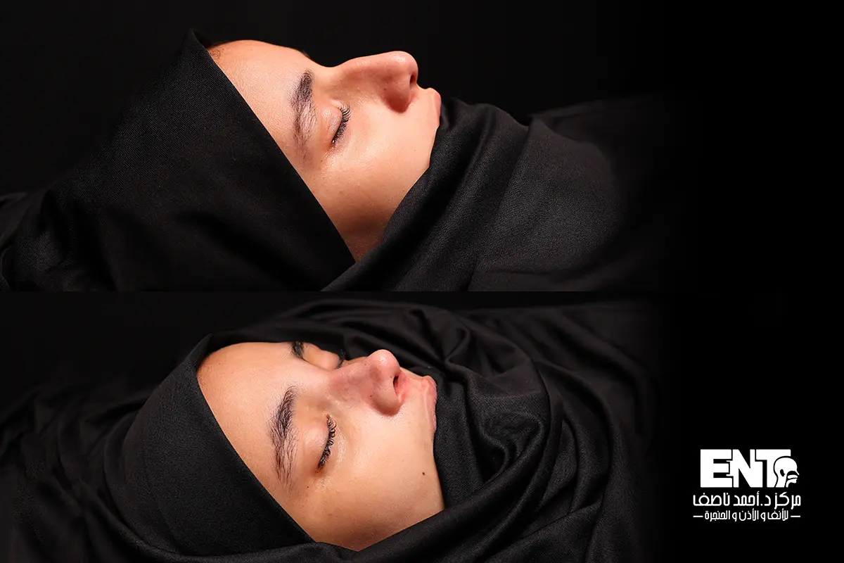 تجميل الأنف اللحمي في منية النصر