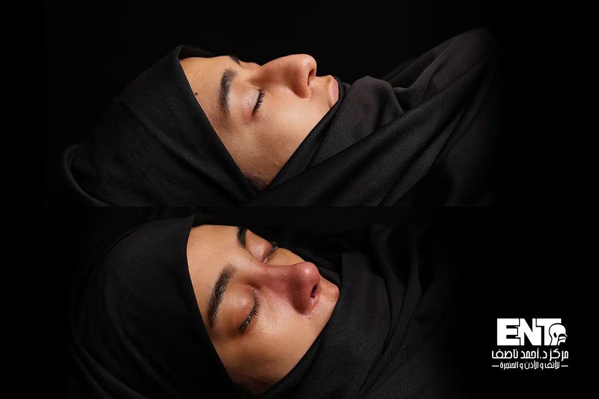تجميل الأنف اللحمي في منية النصر
