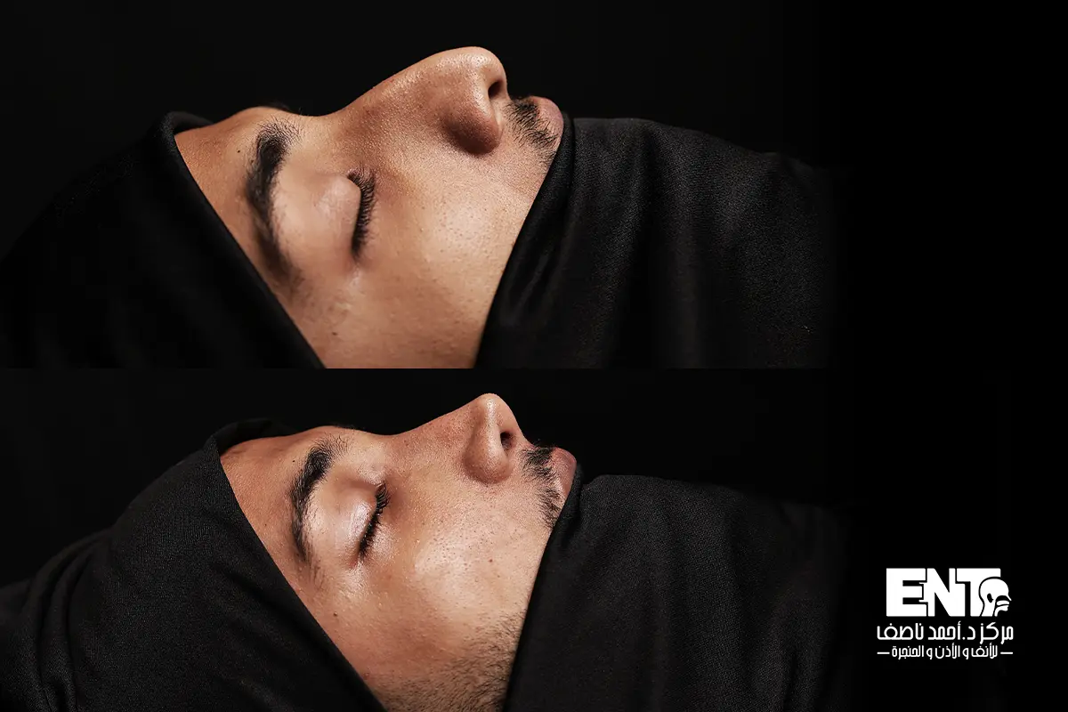 تجميل الانف الوظيفي قبل وبعد مع الدكتور أحمد ناصف